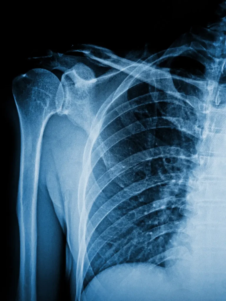 X-ray image of anterior shoulder dislocation showing humeral head out of glenoid socket
